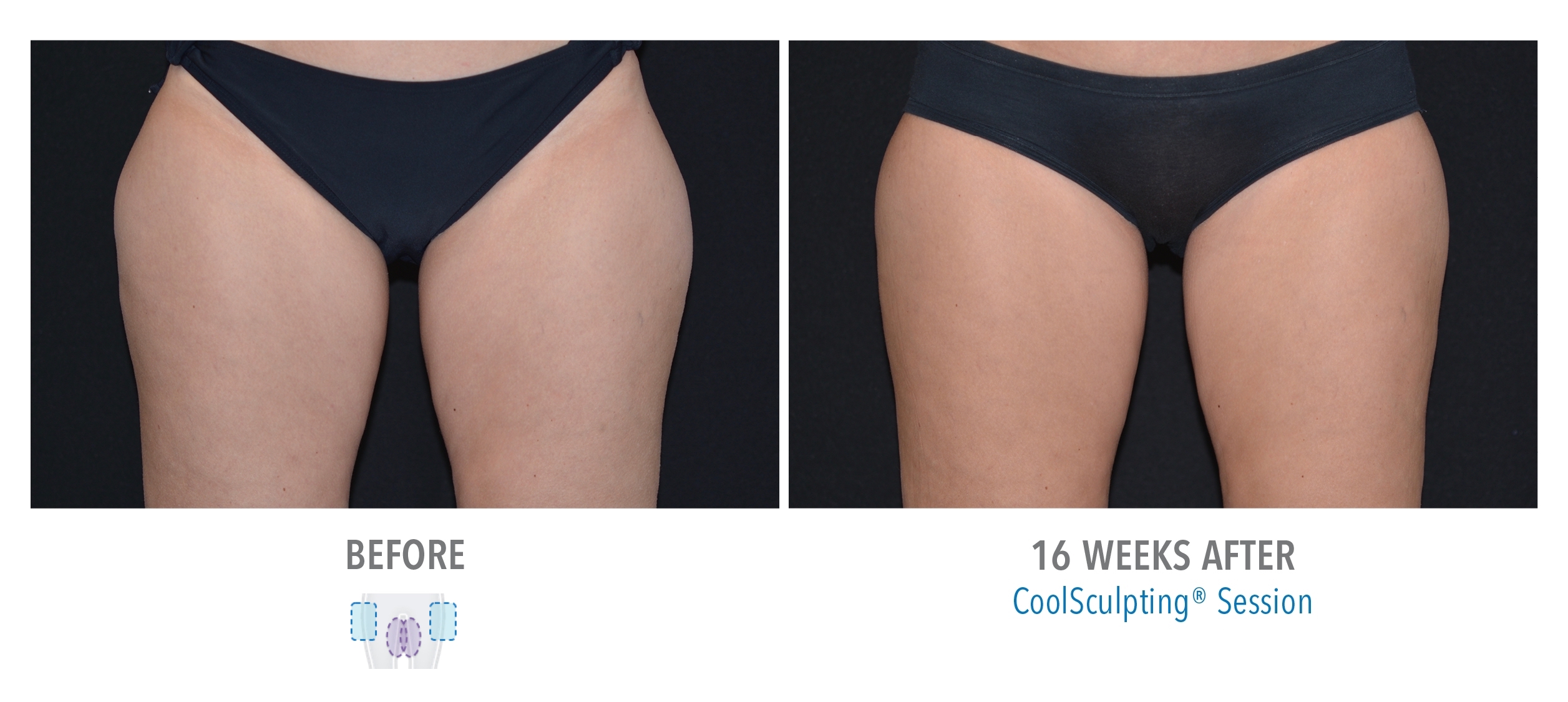 woman receiving coolsculpting