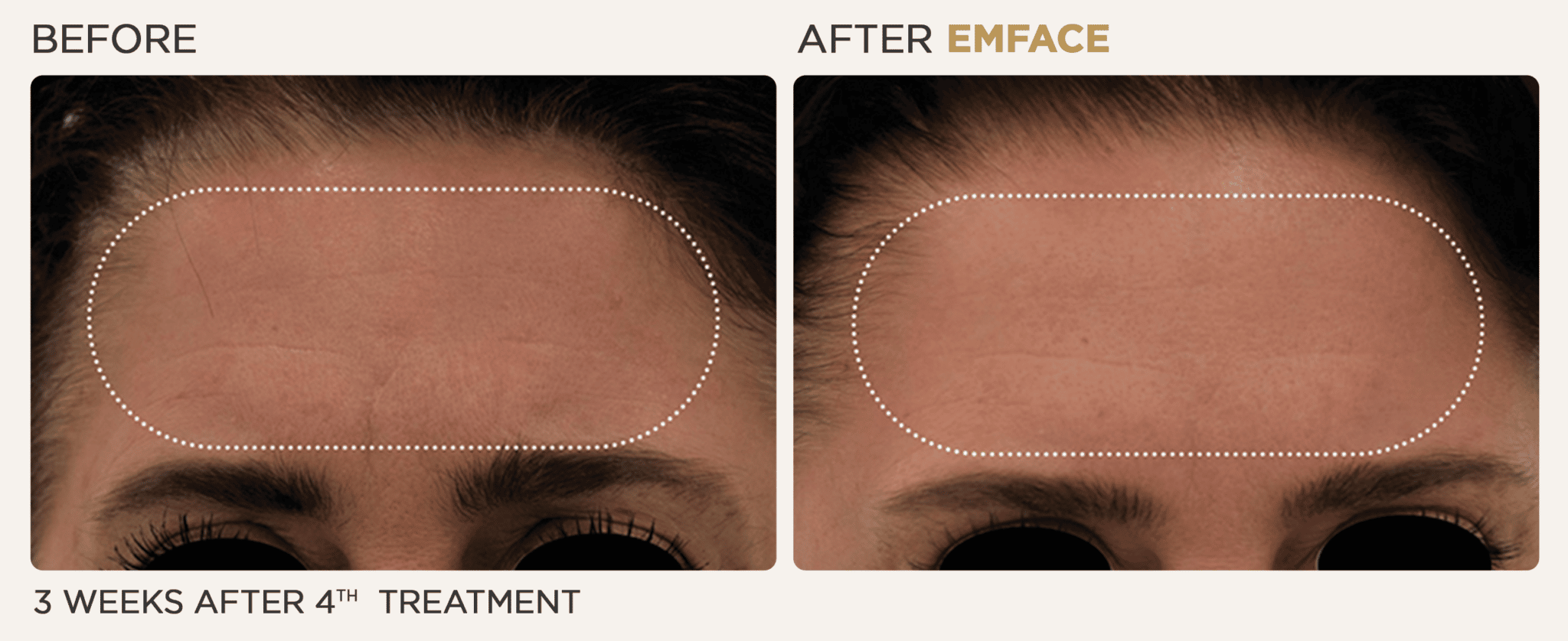 EmFace before and after of a female's forehead