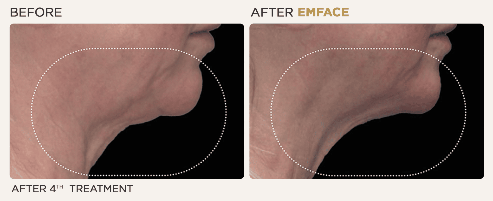 EmFace before and after of a female's neck