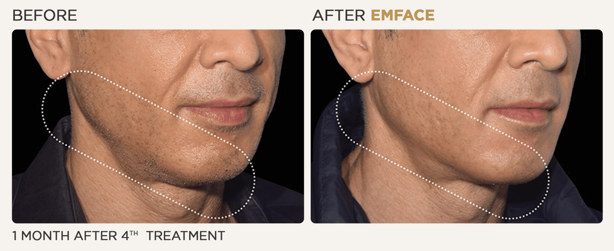 EmFace before and after of a male's chin